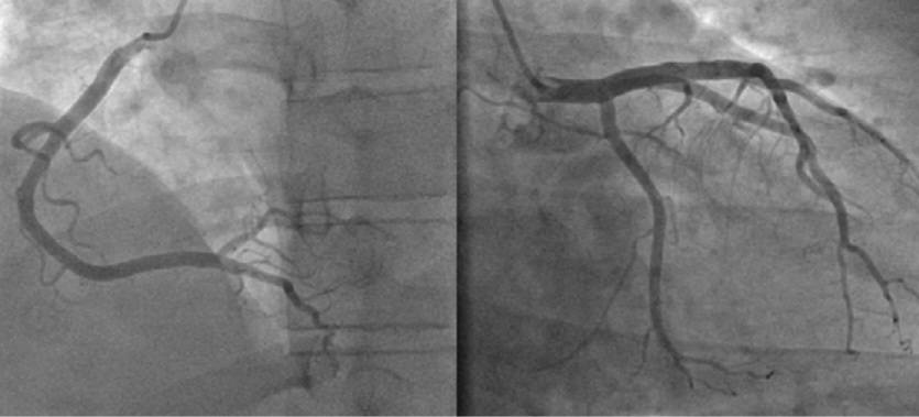 angiogram test in rajshahi