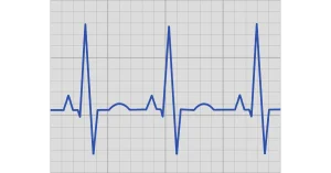 arrhythmia-irregular-heartbeat-dr-rakibul-tushar-rajshahi