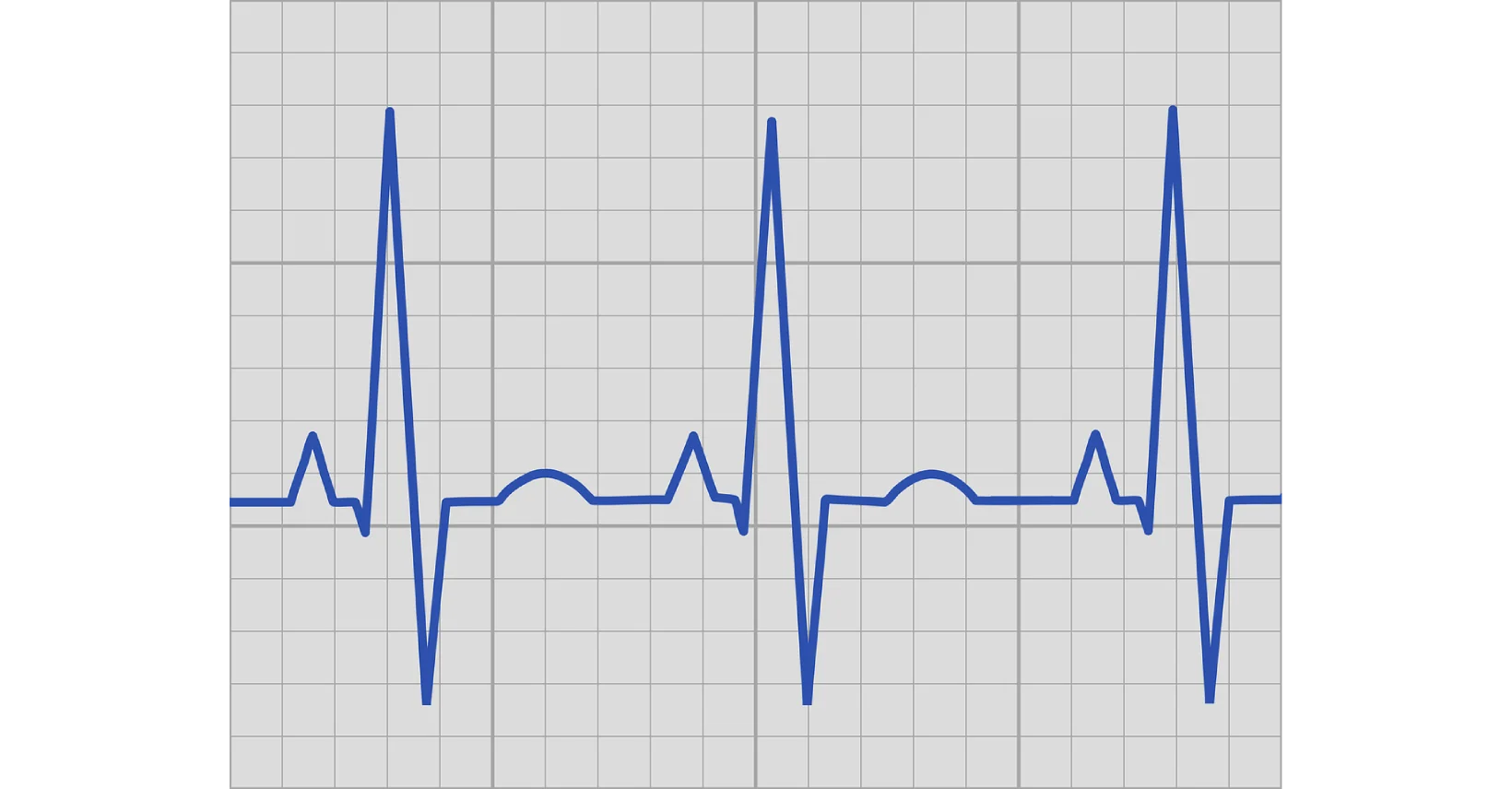 arrhythmia-irregular-heartbeat-dr-rakibul-tushar-rajshahi